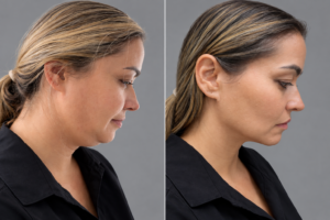 about-aesthetic-practitioner-manchester-lumipro-double-chin-results-2-vasilica