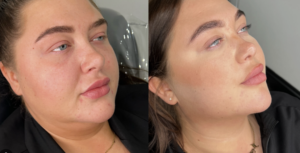 about-aesthetic-practitioner-manchester-lumipro-double-chin-results-3-vasilica