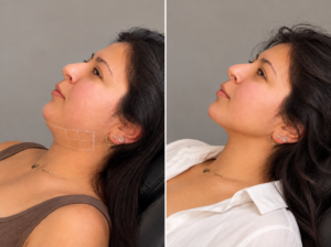 about-aesthetic-practitioner-manchester-lumipro-double-chin-results-vasilica