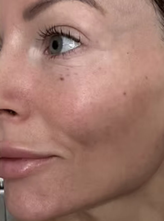 aesthetic-skin-clinic-dermafiller-dukinfield-manchester-tameside
