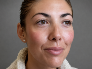 aesthetic-skin-clinic-dermafillers-dukinfield-manchester-tameside