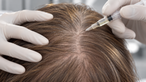 aesthetic-skin-clinic-exosome-microneedling-therapies-dukinfield-manchester-tameside