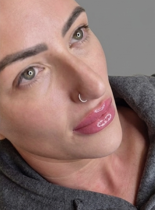 aesthetic-skin-clinic-lip-enchancement-treatments-dukinfield-manchester-tameside