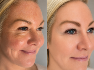aesthetic-skin-clinic-vitamin-injections-dukinfield-manchester-tameside