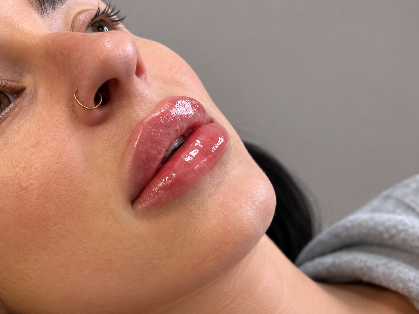 vasilica-manchester-aesthetic-lips-filler-restore-volumen-vasilica