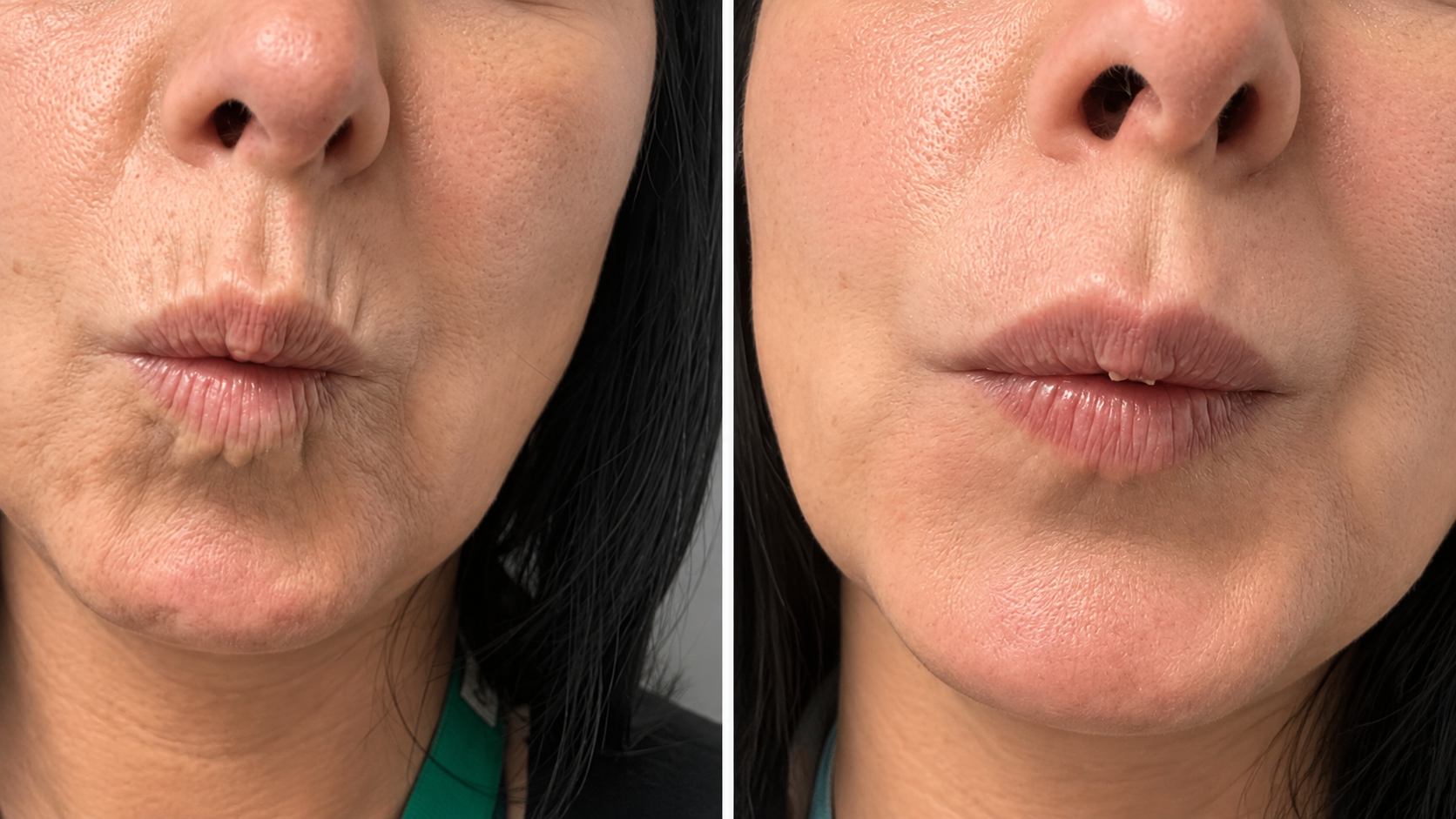 vasilica-manchester-natural-lip-filler-services-aesthetics-pleens